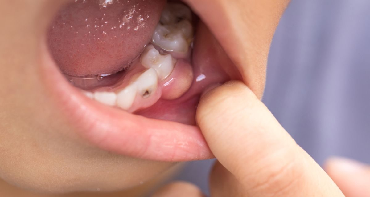 Abses Gusi, Kenali Penyebab, Gejala Dan Cara Penanganannya
