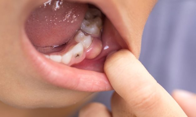 Abses Gusi, Kenali Penyebab, Gejala Dan Cara Penanganannya