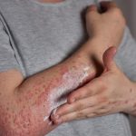 Penyakit Kusta Menyebabkan Kerusakan Serius Jika Tidak Di Obati