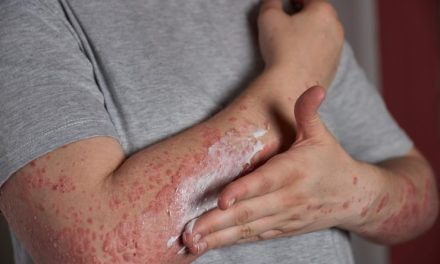 Penyakit Kusta Menyebabkan Kerusakan Serius Jika Tidak Di Obati