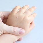 Kutil Dapat Di Sembuhkan Dengan Obat Kalusol, Benarkah?