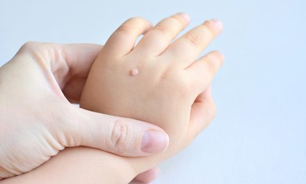 Kutil Dapat Di Sembuhkan Dengan Obat Kalusol, Benarkah?